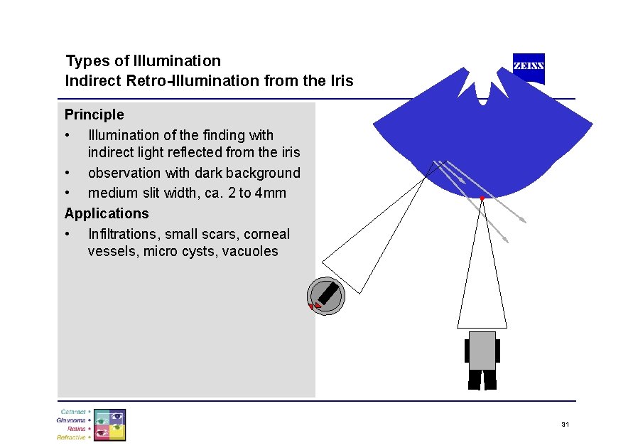 Types of Illumination Indirect Retro-Illumination from the Iris Principle • Illumination of the finding