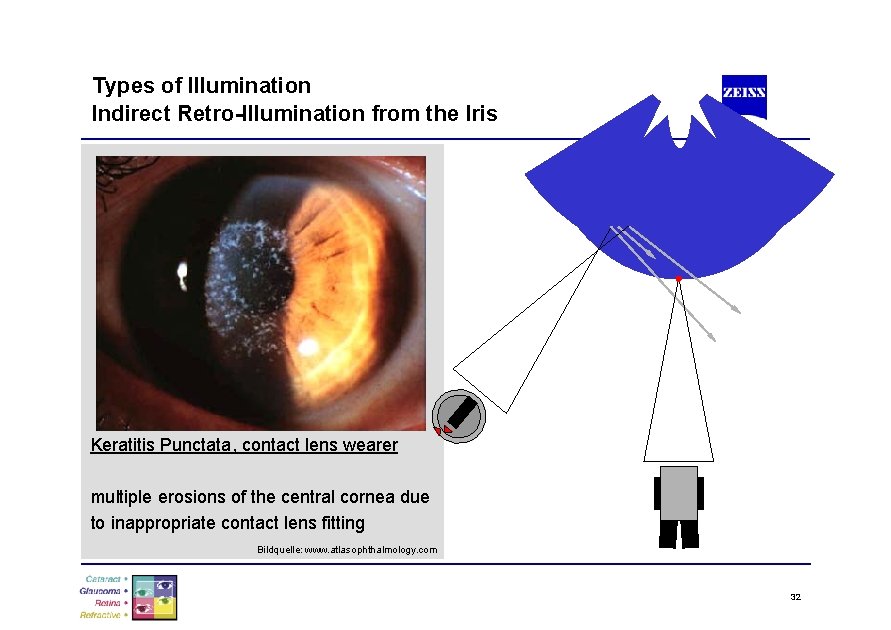 Types of Illumination Indirect Retro-Illumination from the Iris Keratitis Punctata, contact lens wearer multiple