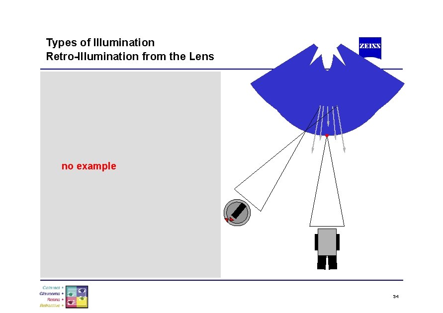 Types of Illumination Retro-Illumination from the Lens no example 34 