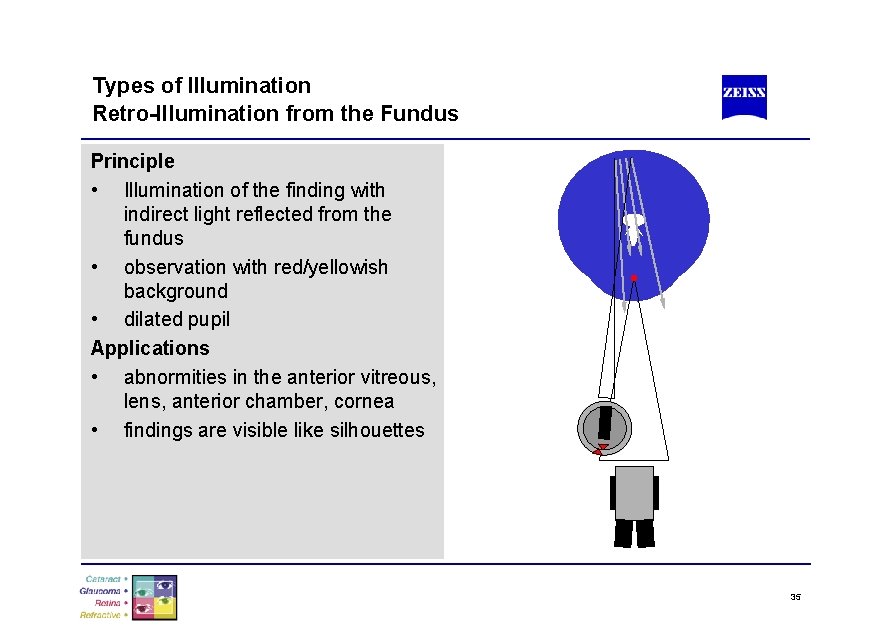 Types of Illumination Retro-Illumination from the Fundus Principle • Illumination of the finding with