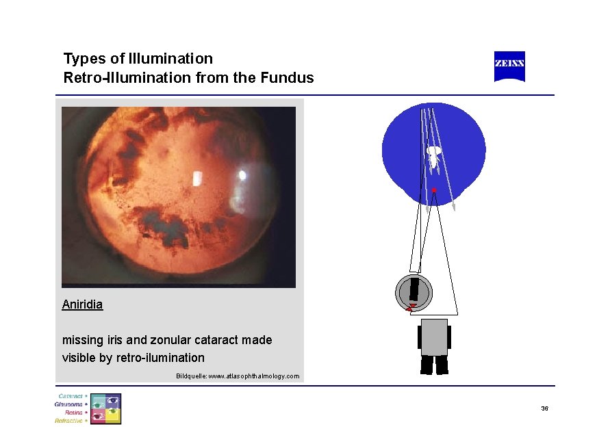 Types of Illumination Retro-Illumination from the Fundus Aniridia missing iris and zonular cataract made