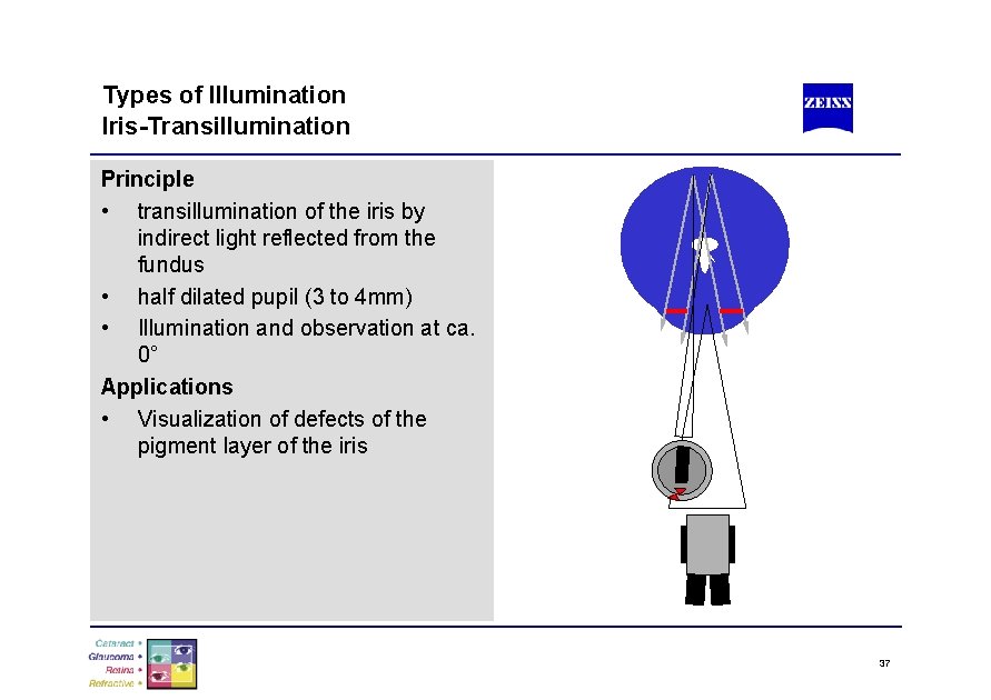Types of Illumination Iris-Transillumination Principle • transillumination of the iris by indirect light reflected