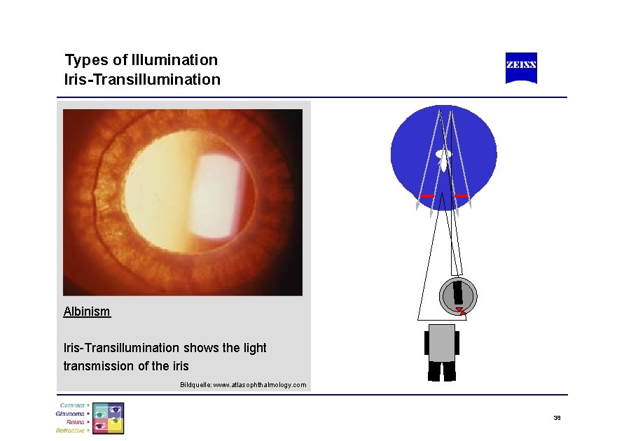Types of Illumination Iris-Transillumination Albinism Iris-Transillumination shows the light transmission of the iris Bildquelle: