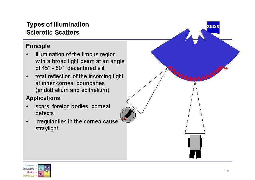 Types of Illumination Sclerotic Scatters Principle • Illumination of the limbus region with a