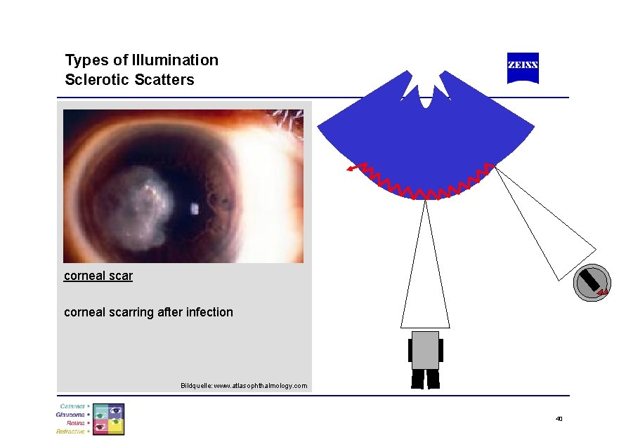 Types of Illumination Sclerotic Scatters corneal scarring after infection Bildquelle: www. atlasophthalmology. com 40