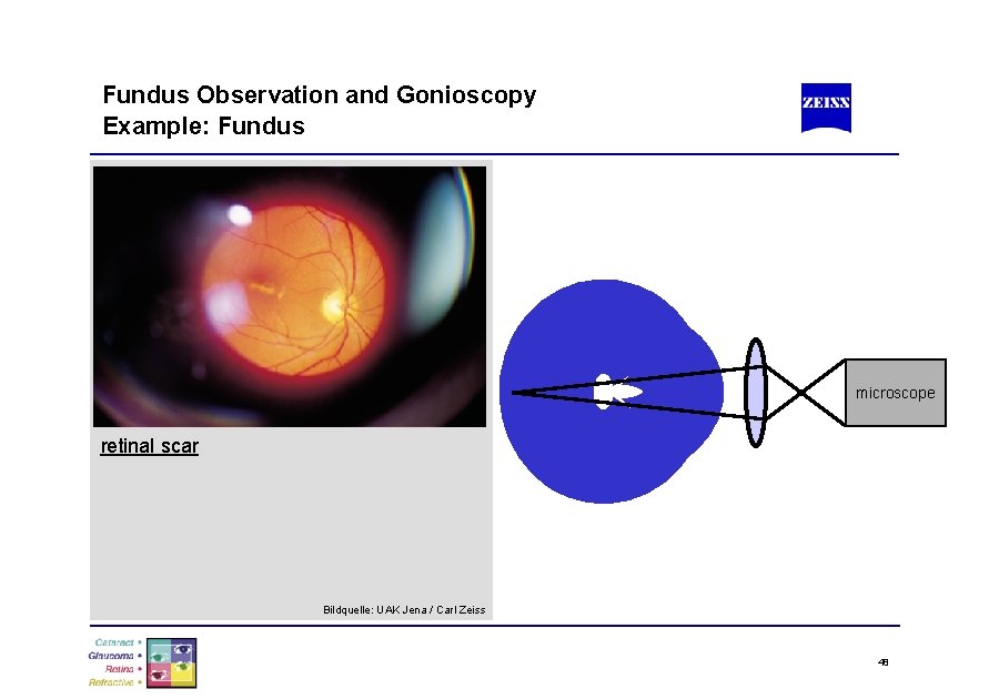 Fundus Observation and Gonioscopy Example: Fundus microscope retinal scar Bildquelle: UAK Jena / Carl