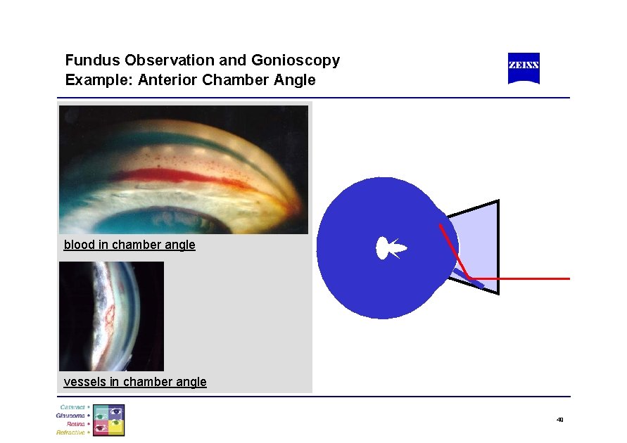 Fundus Observation and Gonioscopy Example: Anterior Chamber Angle blood in chamber angle vessels in