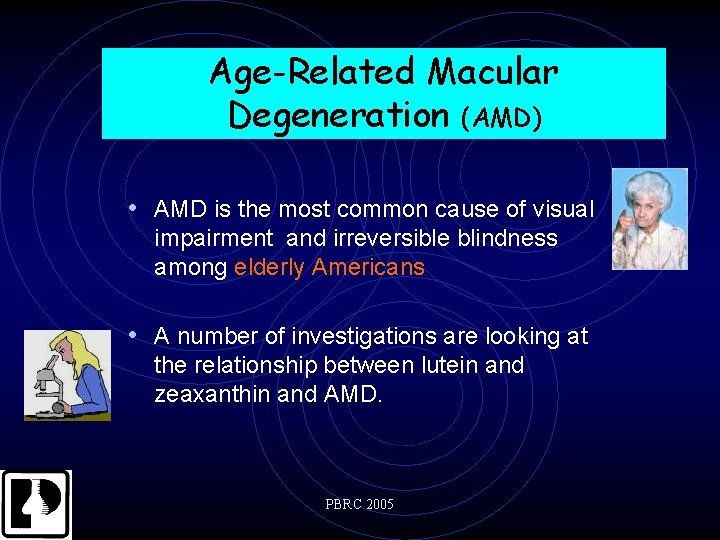 Age-Related Macular Degeneration (AMD) • AMD is the most common cause of visual impairment