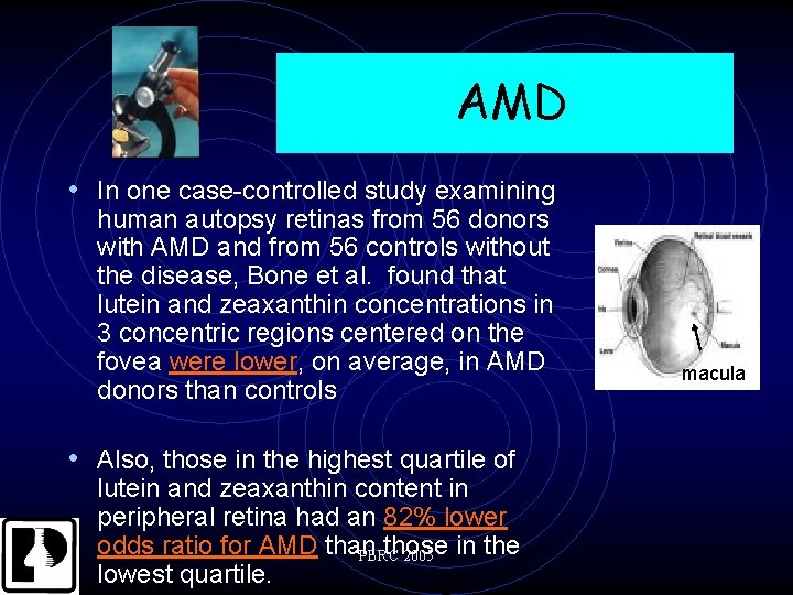 AMD • In one case-controlled study examining human autopsy retinas from 56 donors with
