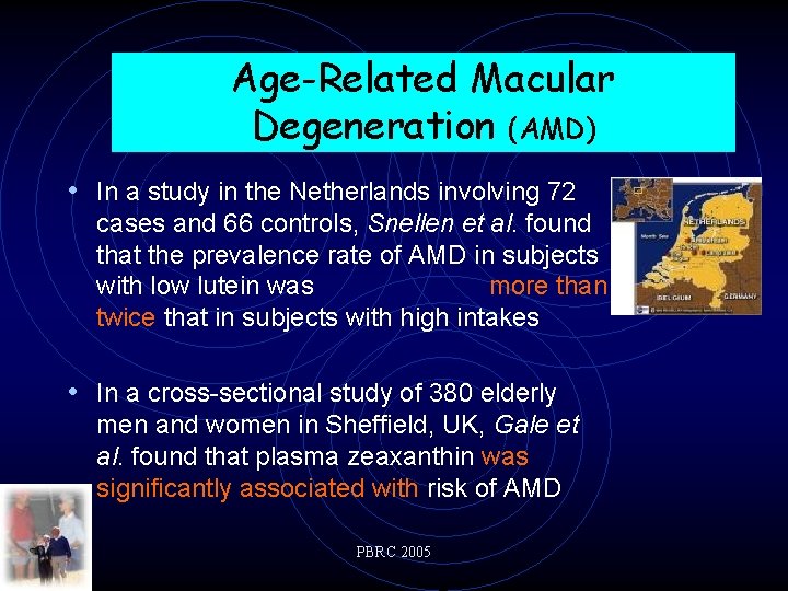 Age-Related Macular Degeneration (AMD) • In a study in the Netherlands involving 72 cases
