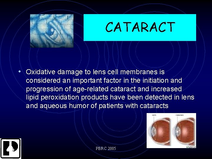 CATARACT • Oxidative damage to lens cell membranes is considered an important factor in