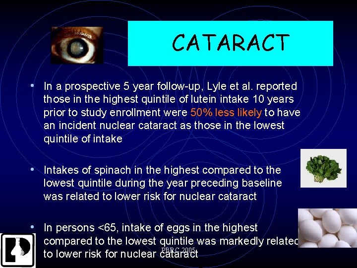 CATARACT • In a prospective 5 year follow-up, Lyle et al. reported those in