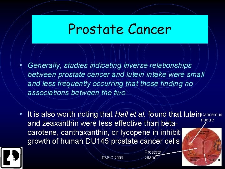 Prostate Cancer • Generally, studies indicating inverse relationships between prostate cancer and lutein intake