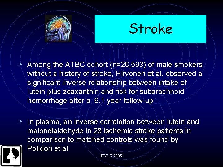 Stroke • Among the ATBC cohort (n=26, 593) of male smokers without a history