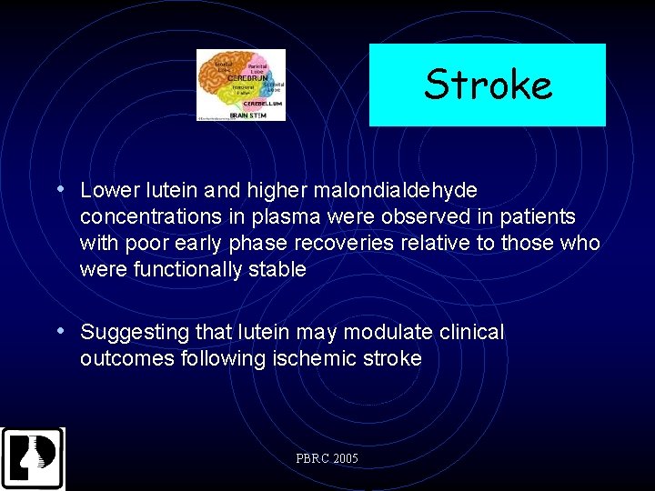 Stroke • Lower lutein and higher malondialdehyde concentrations in plasma were observed in patients