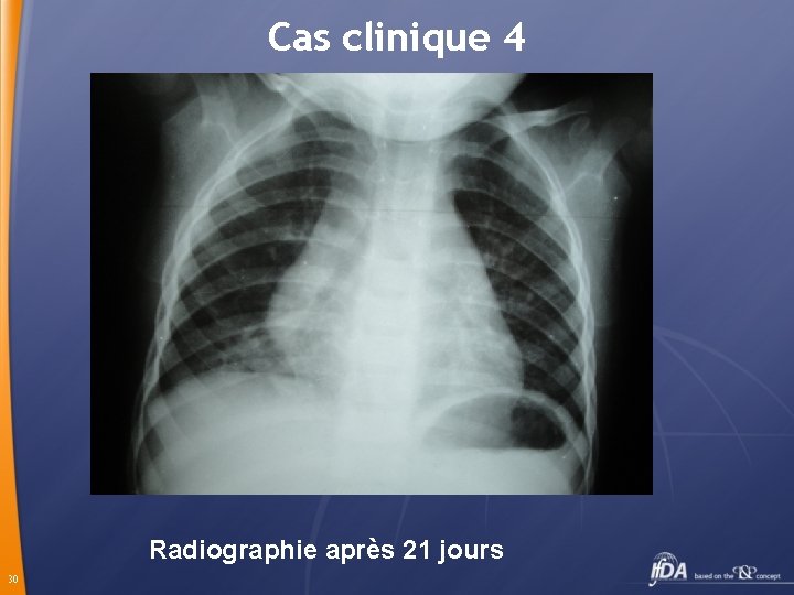 Cas clinique 4 Radiographie après 21 jours 30 
