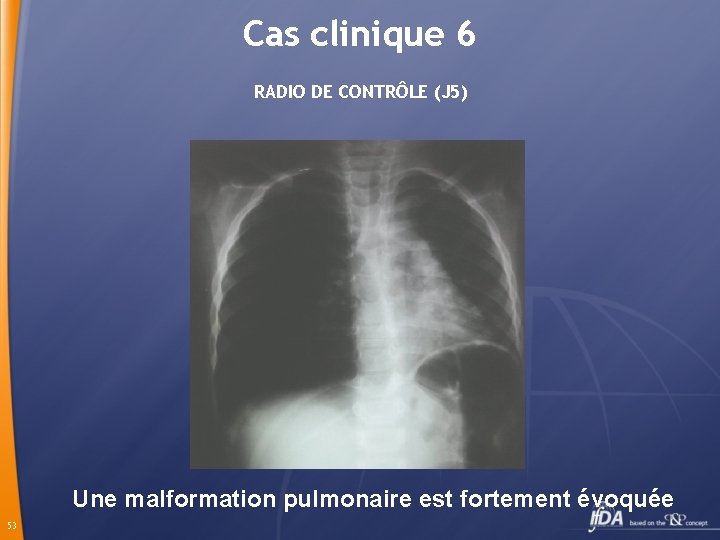 Cas clinique 6 RADIO DE CONTRÔLE (J 5) Une malformation pulmonaire est fortement évoquée