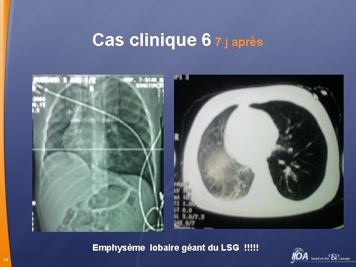 Cas clinique 6 7 j après Emphysème lobaire géant du LSG !!!!! 54 