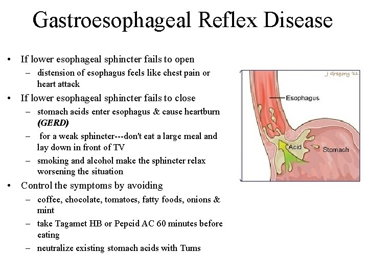 Gastroesophageal Reflex Disease • If lower esophageal sphincter fails to open – distension of