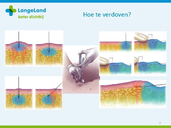 Hoe te verdoven? 7 