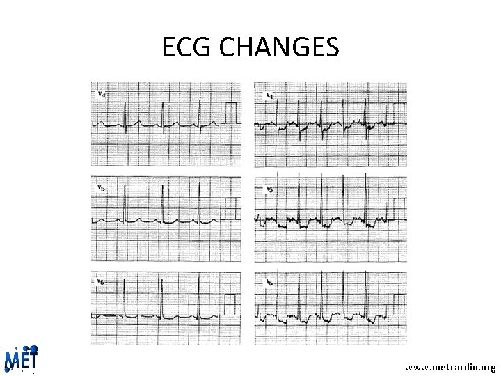 ECG CHANGES www. metcardio. org 