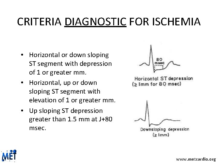 CRITERIA DIAGNOSTIC FOR ISCHEMIA • Horizontal or down sloping ST segment with depression of