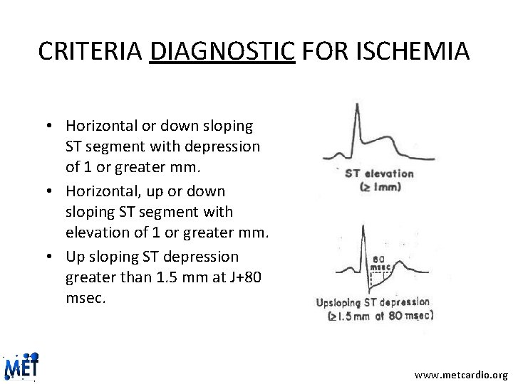 CRITERIA DIAGNOSTIC FOR ISCHEMIA • Horizontal or down sloping ST segment with depression of