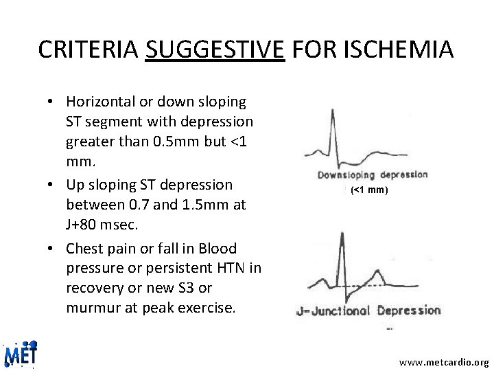 CRITERIA SUGGESTIVE FOR ISCHEMIA • Horizontal or down sloping ST segment with depression greater