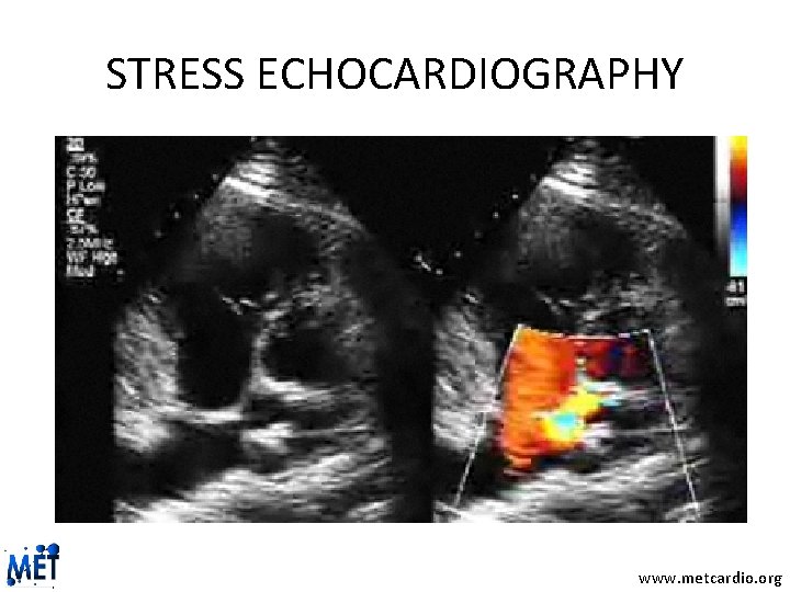 STRESS ECHOCARDIOGRAPHY www. metcardio. org 