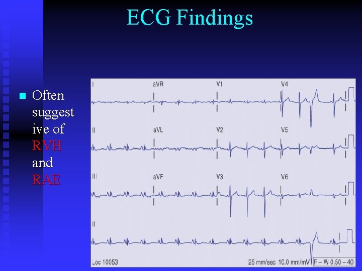 ECG Findings n Often suggest ive of RVH and RAE 