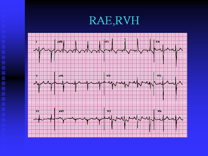 RAE, RVH 