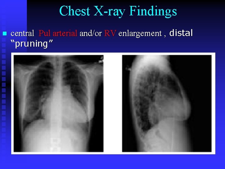 Chest X-ray Findings n central Pul arterial and/or RV enlargement , distal “pruning” 