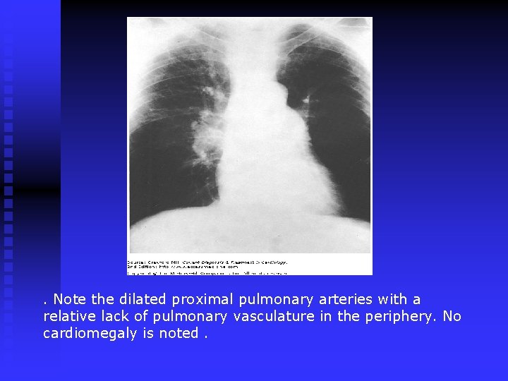 . Note the dilated proximal pulmonary arteries with a relative lack of pulmonary vasculature