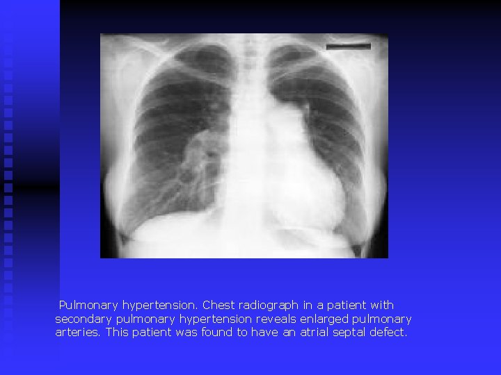 Pulmonary hypertension. Chest radiograph in a patient with secondary pulmonary hypertension reveals enlarged pulmonary