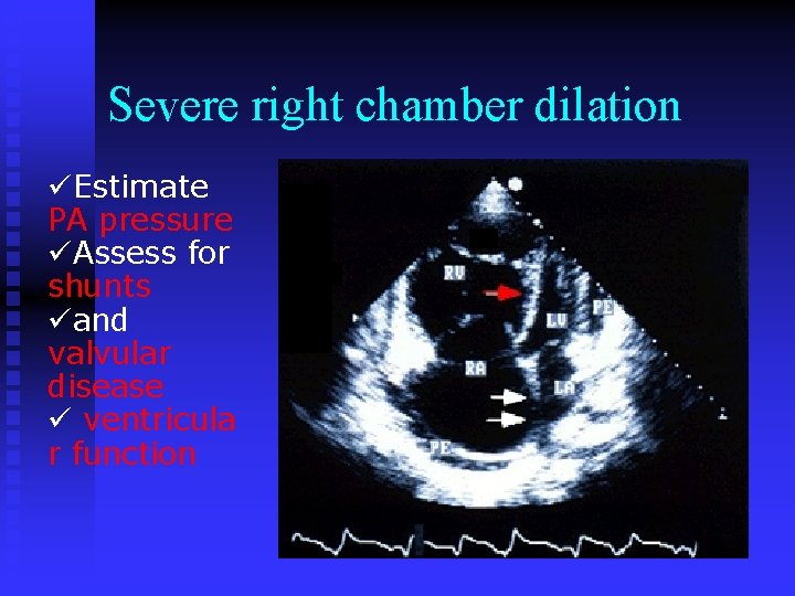 Severe right chamber dilation üEstimate PA pressure üAssess for shunts üand valvular disease ü