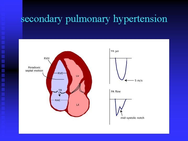 secondary pulmonary hypertension 