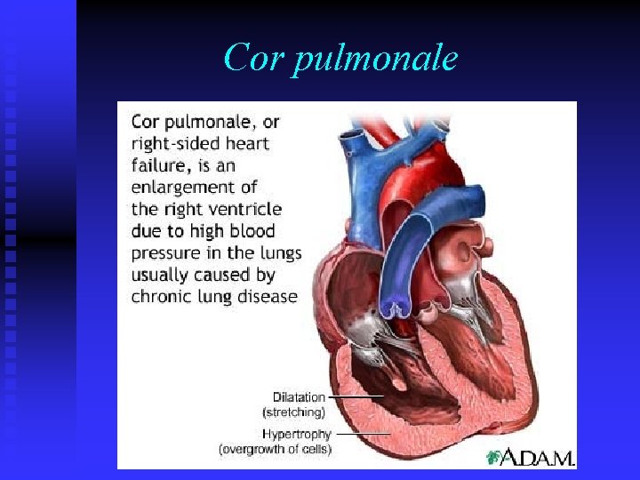 Cor pulmonale 