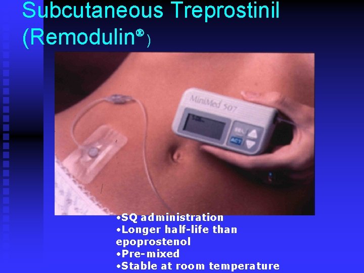 Subcutaneous Treprostinil (Remodulin ) • SQ administration • Longer half-life than epoprostenol • Pre-mixed