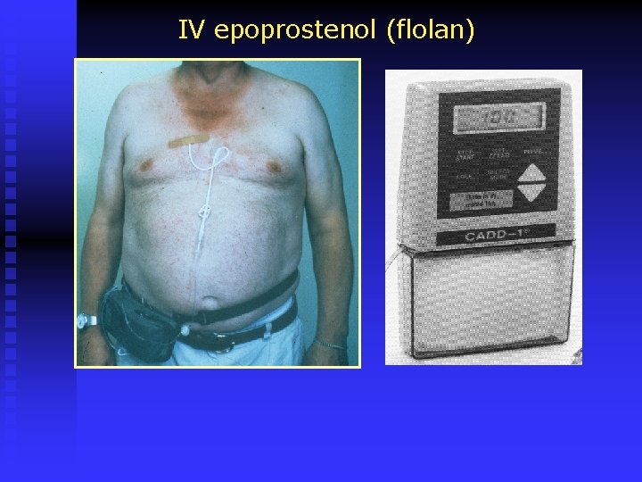 IV epoprostenol (flolan) 