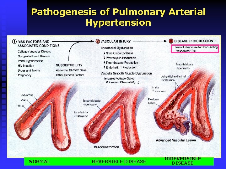 Pathogenesis of Pulmonary Arterial Hypertension NORMAL REVERSIBLE DISEASE IRREVERSIBLE DISEASE 