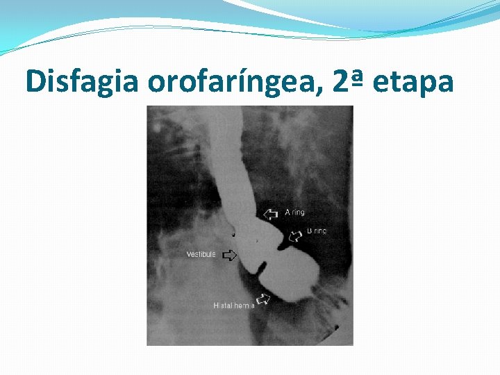 Disfagia orofaríngea, 2ª etapa 