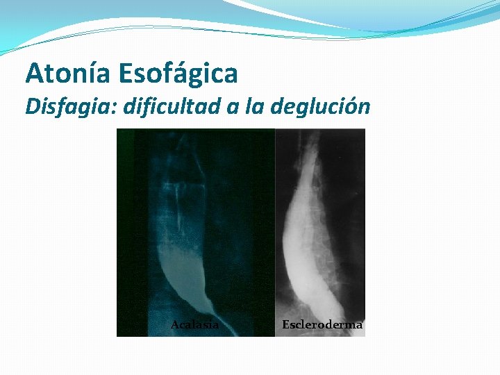 Atonía Esofágica Disfagia: dificultad a la deglución Acalasia Escleroderma 