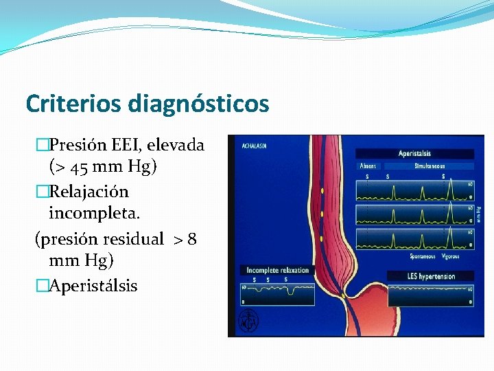 Criterios diagnósticos �Presión EEI, elevada (> 45 mm Hg) �Relajación incompleta. (presión residual >