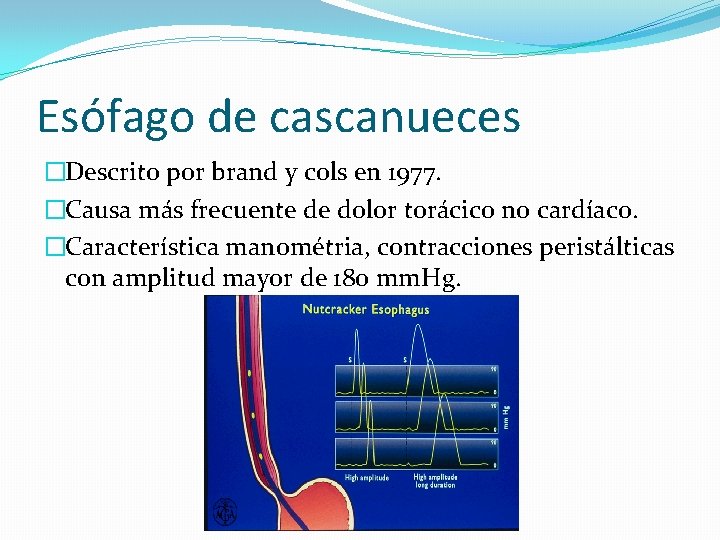 Esófago de cascanueces �Descrito por brand y cols en 1977. �Causa más frecuente de