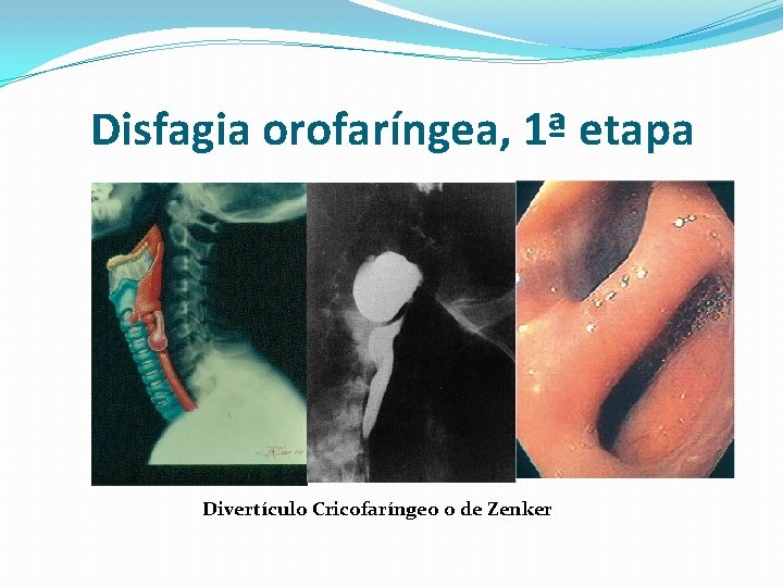 Disfagia orofaríngea, 1ª etapa Divertículo Cricofaríngeo o de Zenker 