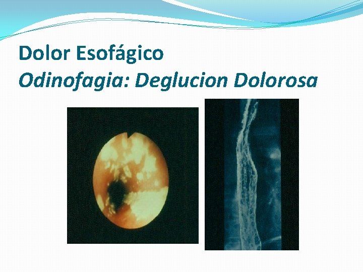 Dolor Esofágico Odinofagia: Deglucion Dolorosa 