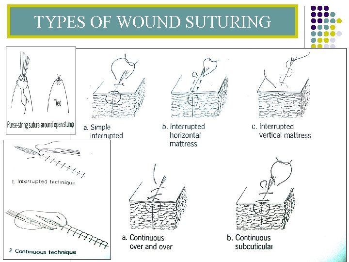 TYPES OF WOUND SUTURING 