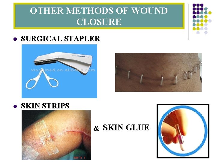 OTHER METHODS OF WOUND CLOSURE l SURGICAL STAPLER l SKIN STRIPS & SKIN GLUE