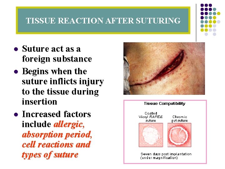 TISSUE REACTION AFTER SUTURING l l l Suture act as a foreign substance Begins