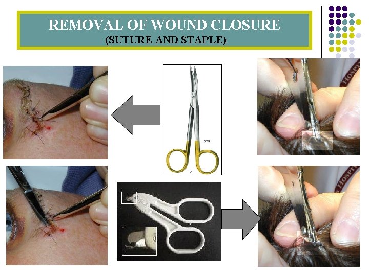 REMOVAL OF WOUND CLOSURE (SUTURE AND STAPLE) 